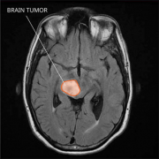 【脑部胶质瘤】脑部胶质瘤有效的治疗方法有哪些？