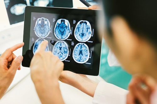 胶质瘤出国看病 胶质瘤治疗     胶质母细胞瘤(glioblastoma