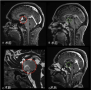 世界颅底主席手术视频演示：如何切除复杂后视交叉性巨大颅咽