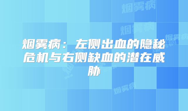 烟雾病：左侧出血的隐秘危机与右侧缺血的潜在威胁