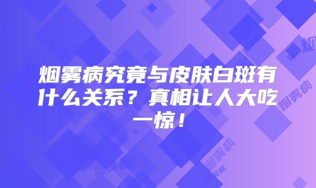 烟雾病究竟与皮肤白斑有什么关系？真相让人大吃一惊！