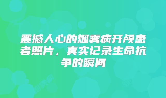 震撼人心的烟雾病开颅患者照片，真实记录生命抗争的瞬间