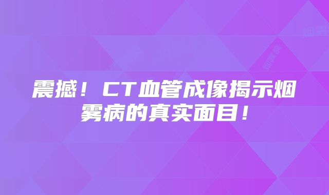 震撼！CT血管成像揭示烟雾病的真实面目！
