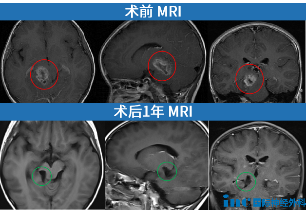 首战即决战？走对这一步后的她从高级别胶质瘤下“死里逃生”！
