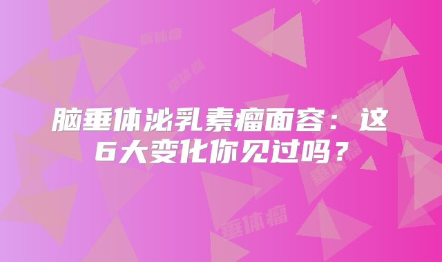 脑垂体泌乳素瘤面容：这6大变化你见过吗？