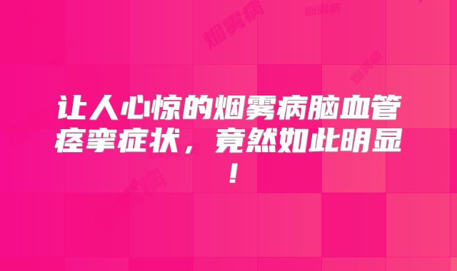 让人心惊的烟雾病脑血管痉挛症状，竟然如此明显！