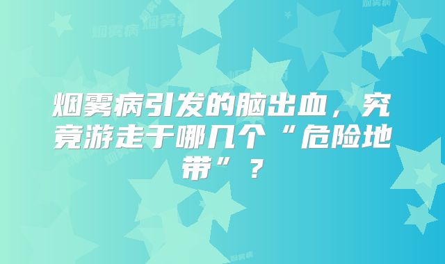 烟雾病引发的脑出血，究竟游走于哪几个“危险地带”？