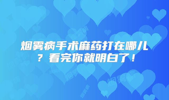 烟雾病手术麻药打在哪儿？看完你就明白了！