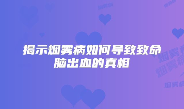 揭示烟雾病如何导致致命脑出血的真相