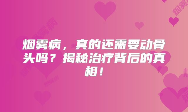 烟雾病，真的还需要动骨头吗？揭秘治疗背后的真相！
