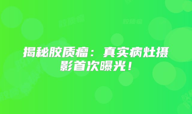 揭秘胶质瘤：真实病灶摄影首次曝光！