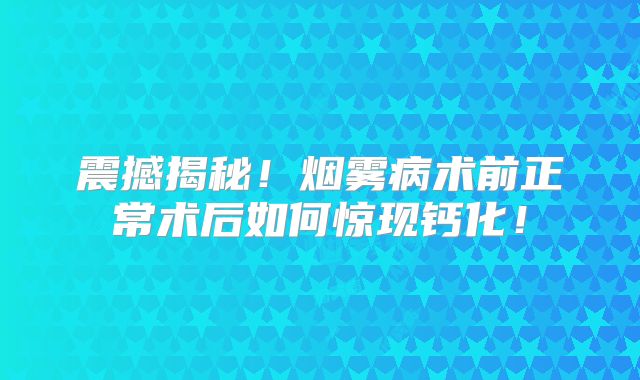 震撼揭秘！烟雾病术前正常术后如何惊现钙化！