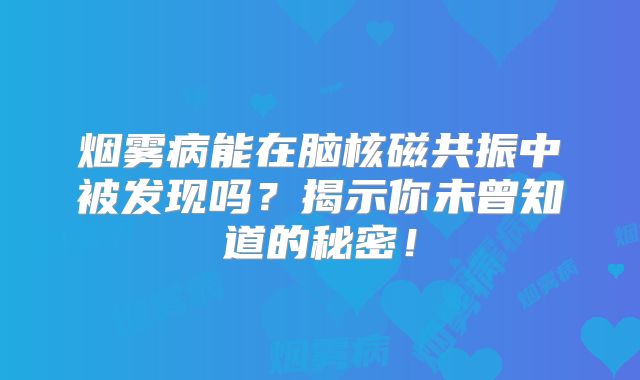 烟雾病能在脑核磁共振中被发现吗？揭示你未曾知道的秘密！