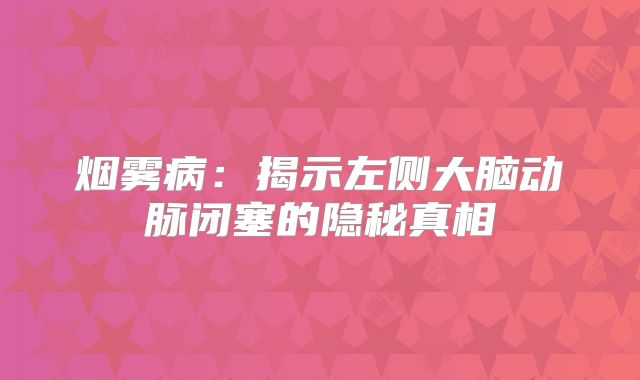烟雾病：揭示左侧大脑动脉闭塞的隐秘真相