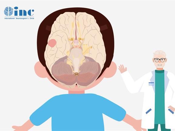 突变形星形细胞瘤究竟有多危险？深度解析！