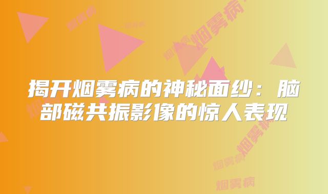 揭开烟雾病的神秘面纱：脑部磁共振影像的惊人表现