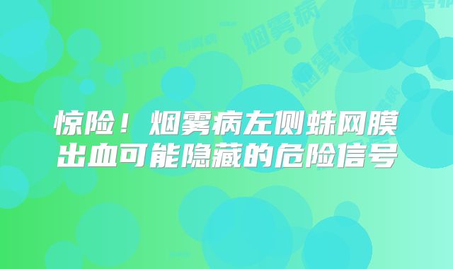 惊险！烟雾病左侧蛛网膜出血可能隐藏的危险信号