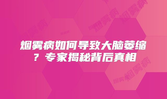 烟雾病如何导致大脑萎缩？专家揭秘背后真相