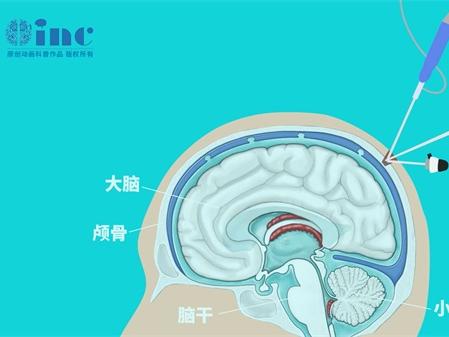 胶质瘤晚期眼睛失明的原因及应对策略！