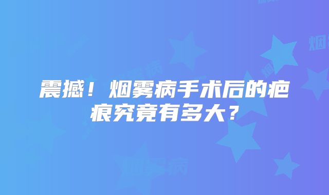 震撼！烟雾病手术后的疤痕究竟有多大？