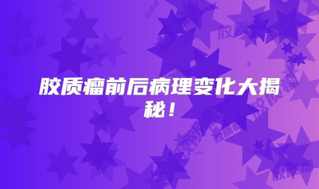 胶质瘤前后病理变化大揭秘！