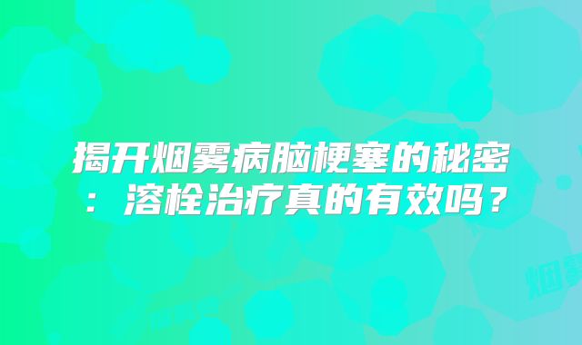 揭开烟雾病脑梗塞的秘密：溶栓治疗真的有效吗？