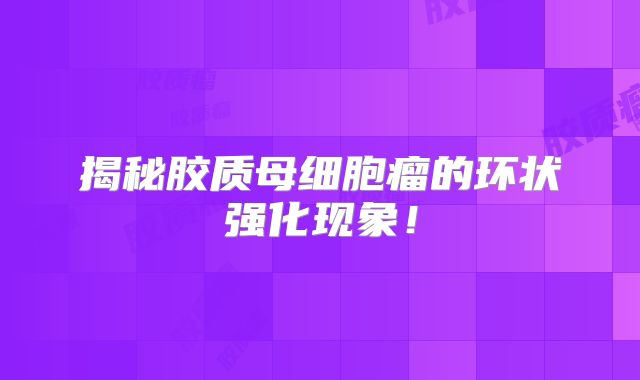 揭秘胶质母细胞瘤的环状强化现象！