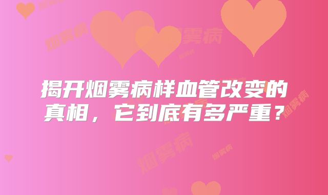 揭开烟雾病样血管改变的真相，它到底有多严重？