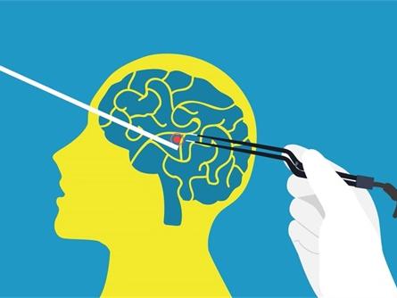 低度毛粘液型星形细胞瘤：如何有效管理与应对？