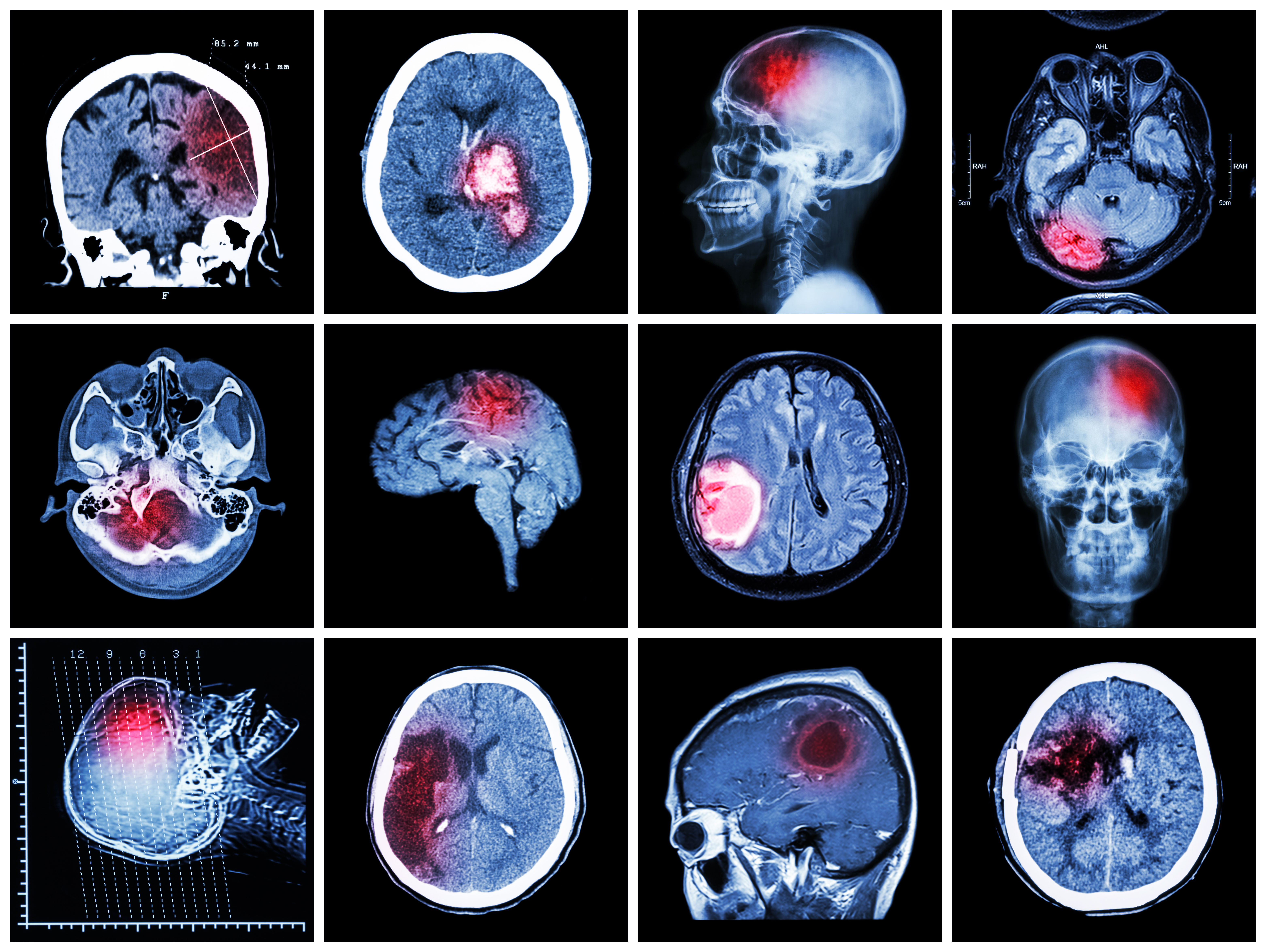 脑胶质瘤的特点有哪些？