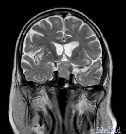 垂体瘤案例图片
