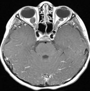 哪些脑瘤能够进行质子治疗？