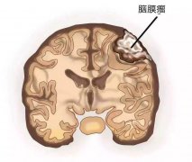 小脑幕脑膜瘤临床表现是什么？