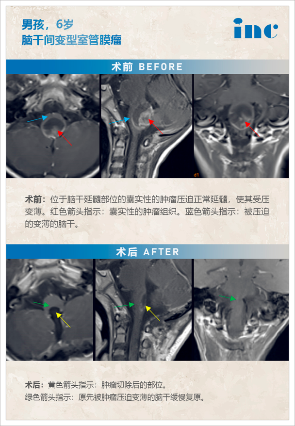 恶性脑干间变型室管膜瘤