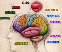 【胶质瘤治疗】治疗胶质瘤有哪些主要方式？