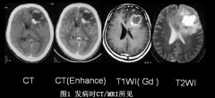 <b>【胶质瘤复发】治疗的胶质瘤手术治疗后复发案例</b>