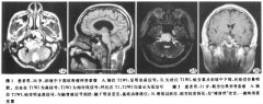 【脊索瘤症状】颅底脊索瘤的MR表现怎么样？