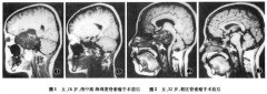 颅底脊索瘤如何治疗以及脊索瘤分类