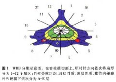 颈椎脊索瘤的临床特点及外科治疗