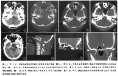 斜坡脊索瘤螺旋CT表现及鉴别诊断