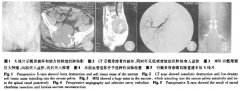 【脊索瘤治疗】骶骨脊索瘤的临床特点有哪些？