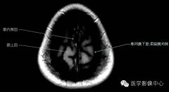 【脑磁共振】颅脑磁共振HD高清图片集