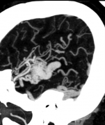 【脑血管瘤】脑血管畸形影像诊断是否有必要？