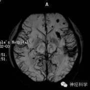 【癫痫病因】一例关于儿童癫痫病因的案例