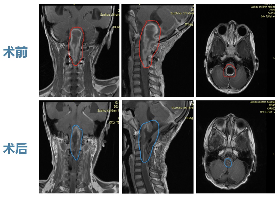 脑胶质瘤术前术后