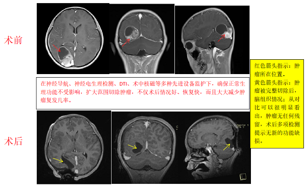 胶质瘤案例,胶质瘤手术