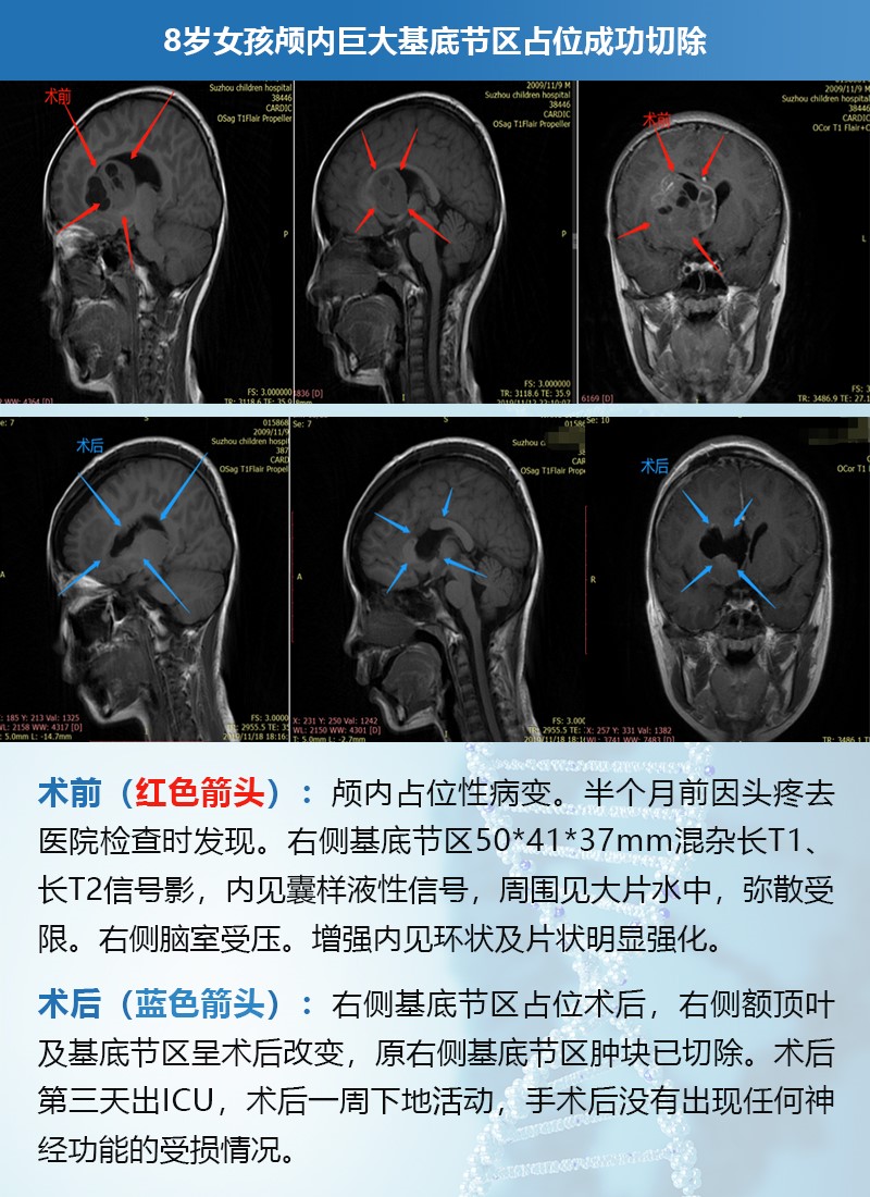 脑瘤案例