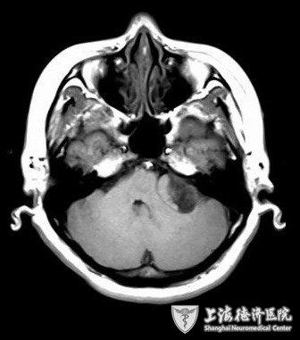 脑干胶质瘤发病部位的症状