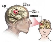 脑部胶质瘤患者治疗与饮食注意事项