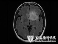 儿童脑肿瘤临床病因的解析